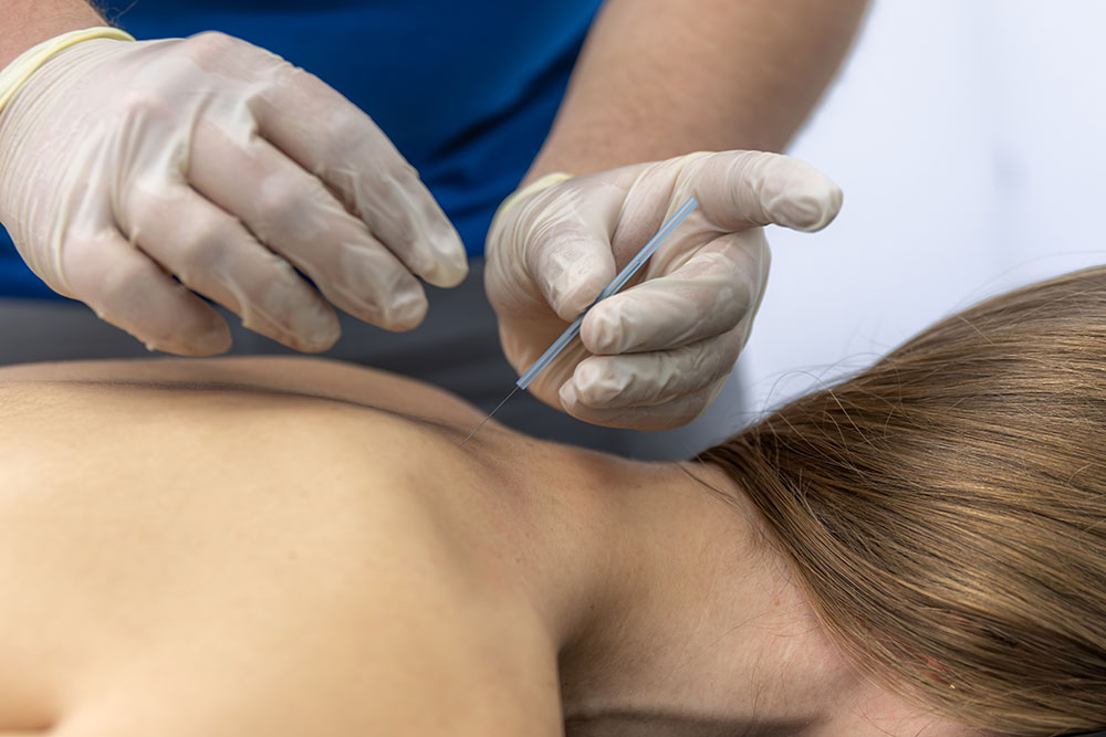 Dry needling treatment